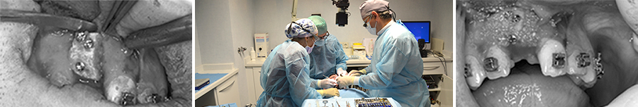 formación en implantología cirugía de injerto óseo